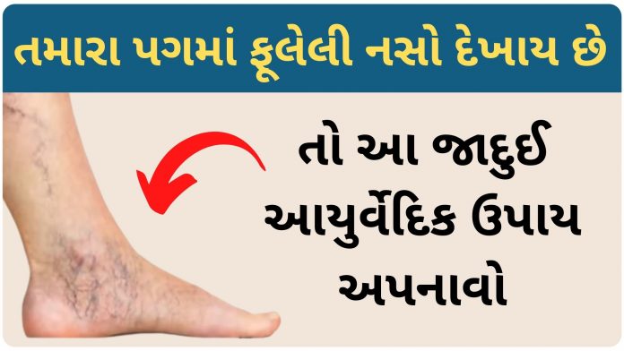 varicose veins ayurveda treatment in gujarati