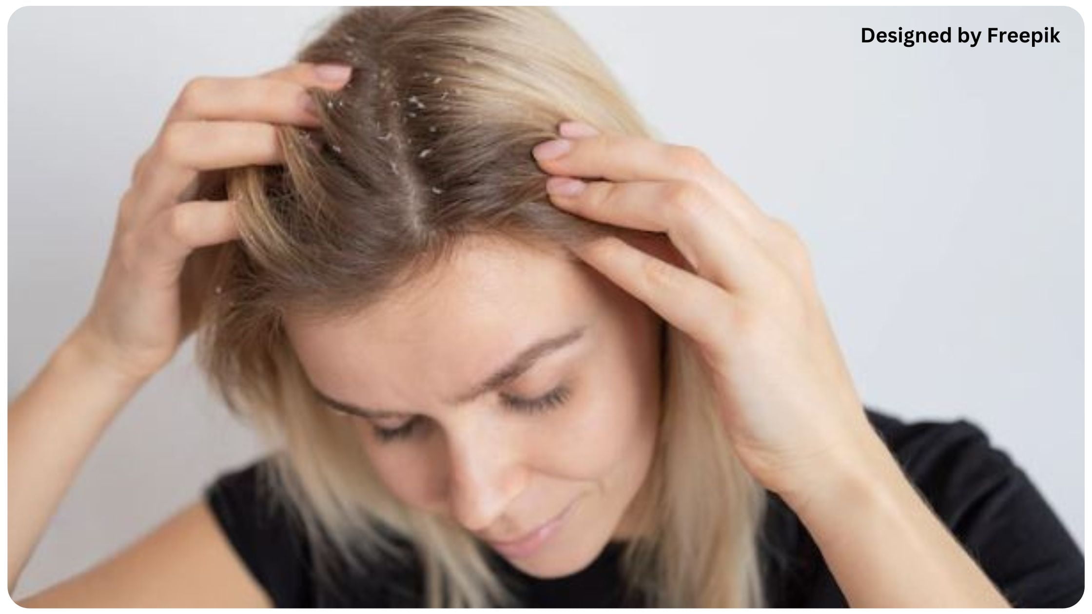 hair dandruff treatment at home in gujarati