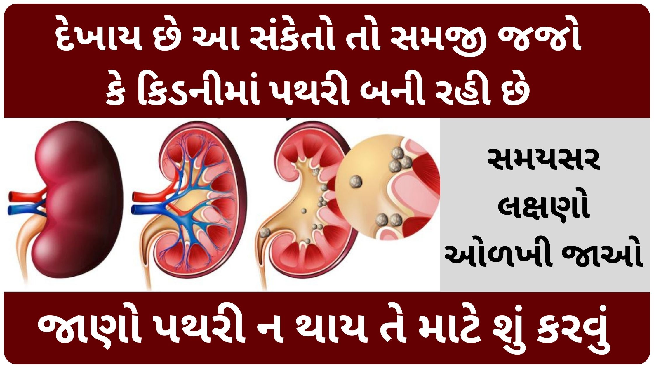 kidney stone symptoms