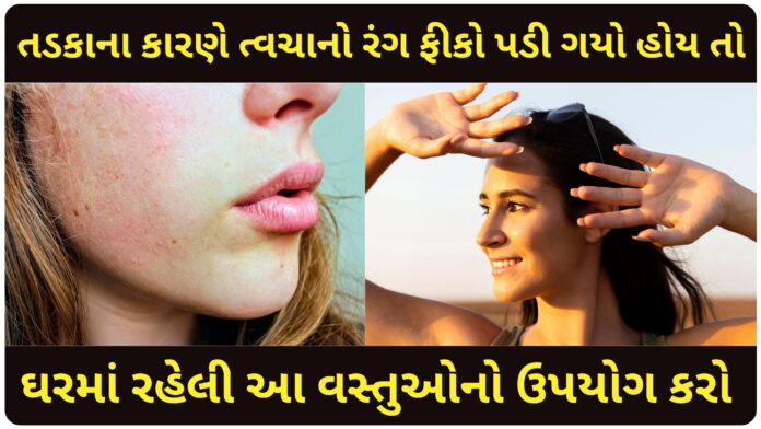 sunburn home remedies